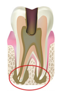 膜 炎 歯根 噛んだときに痛みがあると歯根膜炎かも?症状・原因や治療方法を解説