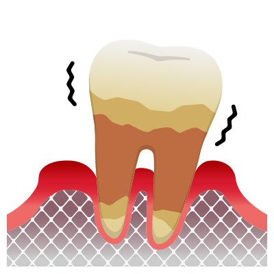 重度歯周炎の概要（症状や状態）