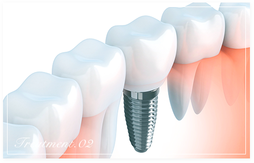 新しい歯を入れる「インプラント治療」